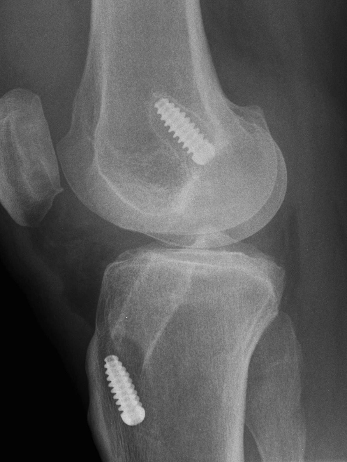 Tibial and femoral tunnel Lysis